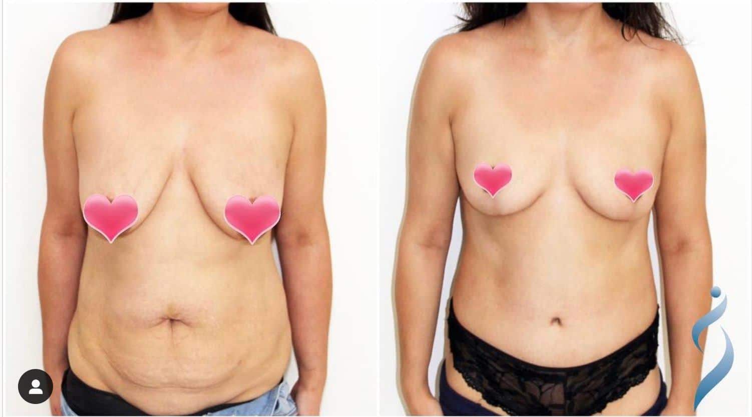 A before and after of a woman who has had a tummy tuck (abdominoplasty) procedure