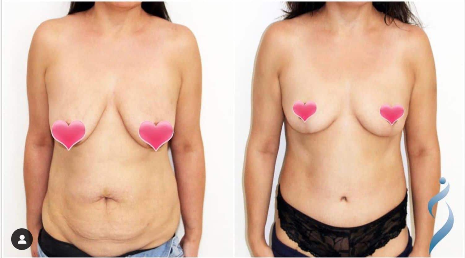 How Much Does Tummy Tuck (Abdominoplasty) Cost? (See Prices Near