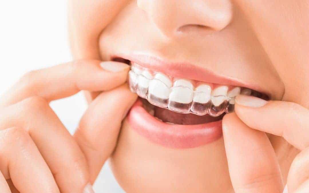 Invisalign – Straighten Your Teeth The Invisible Way