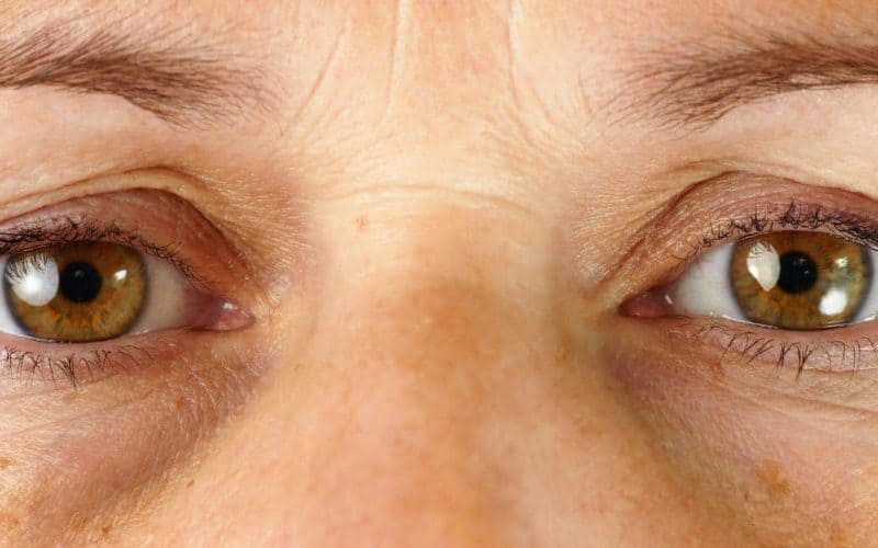Do You Have Raccoon Eyes? What Causes Them and How to Fix It