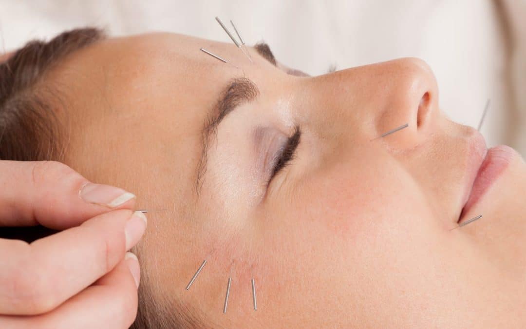 Facial Acupuncture – Can It Make You Look Younger?