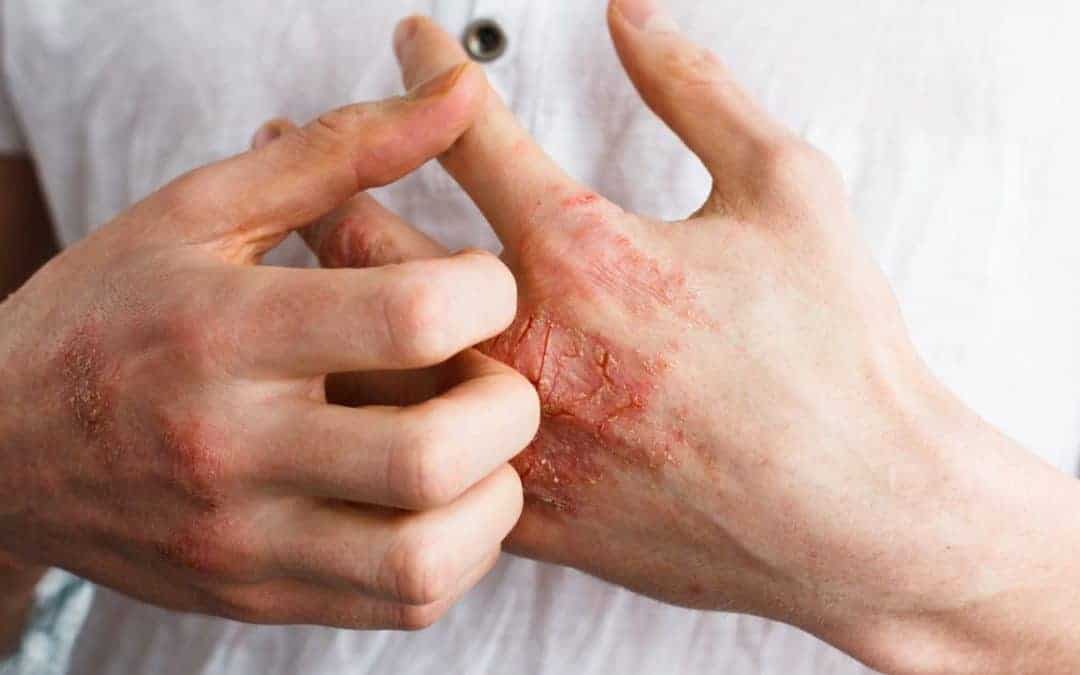 Is There A Cure For Eczema And Psoriasis?