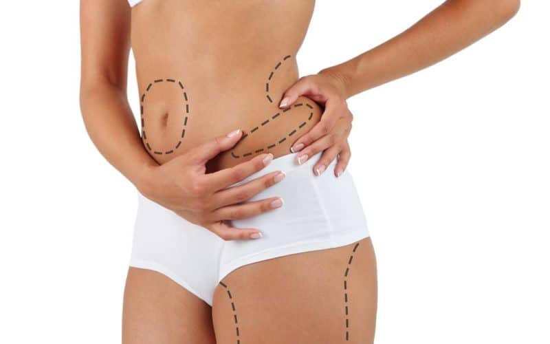 What Does Liposuction Cost in Australia?