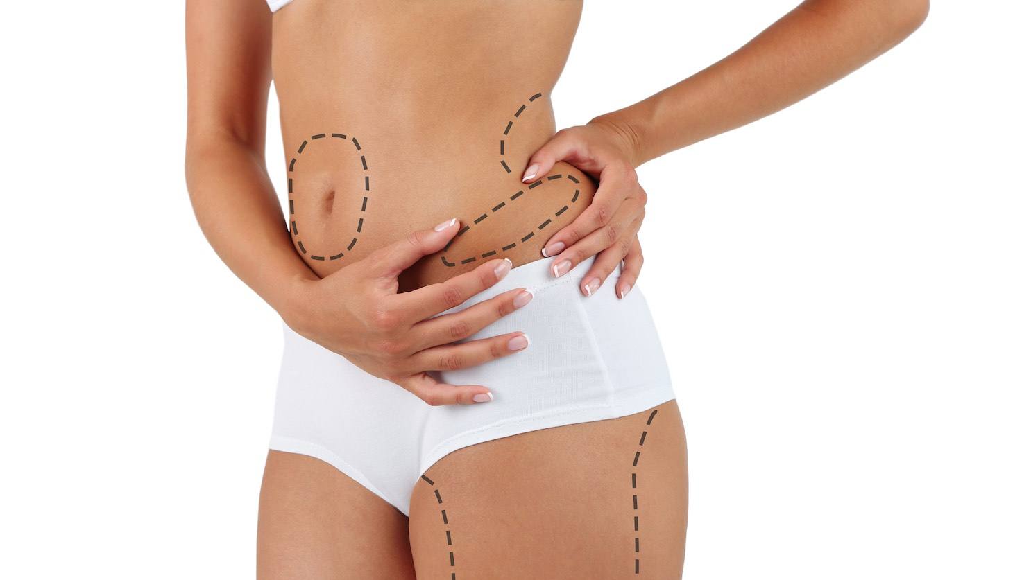 Liposuction of the Muffin Top Waistline Deformity - Explore Plastic Surgery