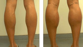 Calf Augmentation - Before and After