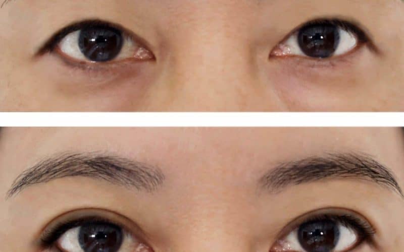 Blepharoplasty In The Spotlight