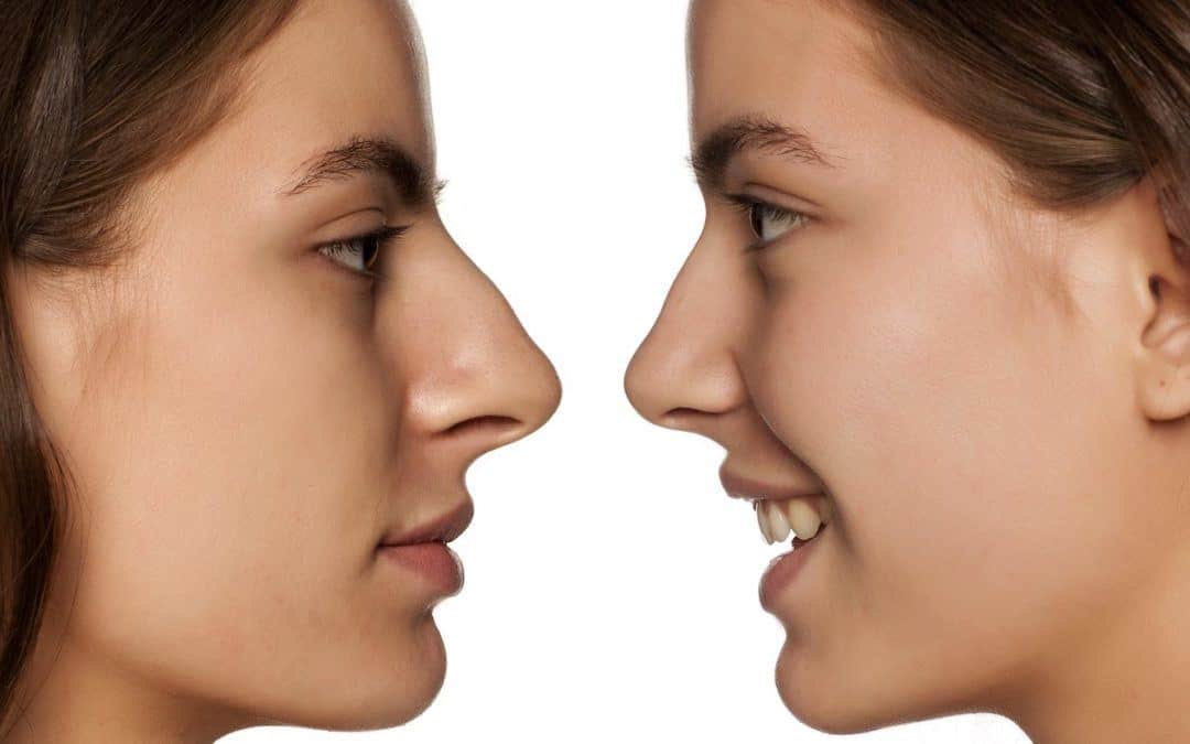 Want a Faster Recovery After a Nose Job?