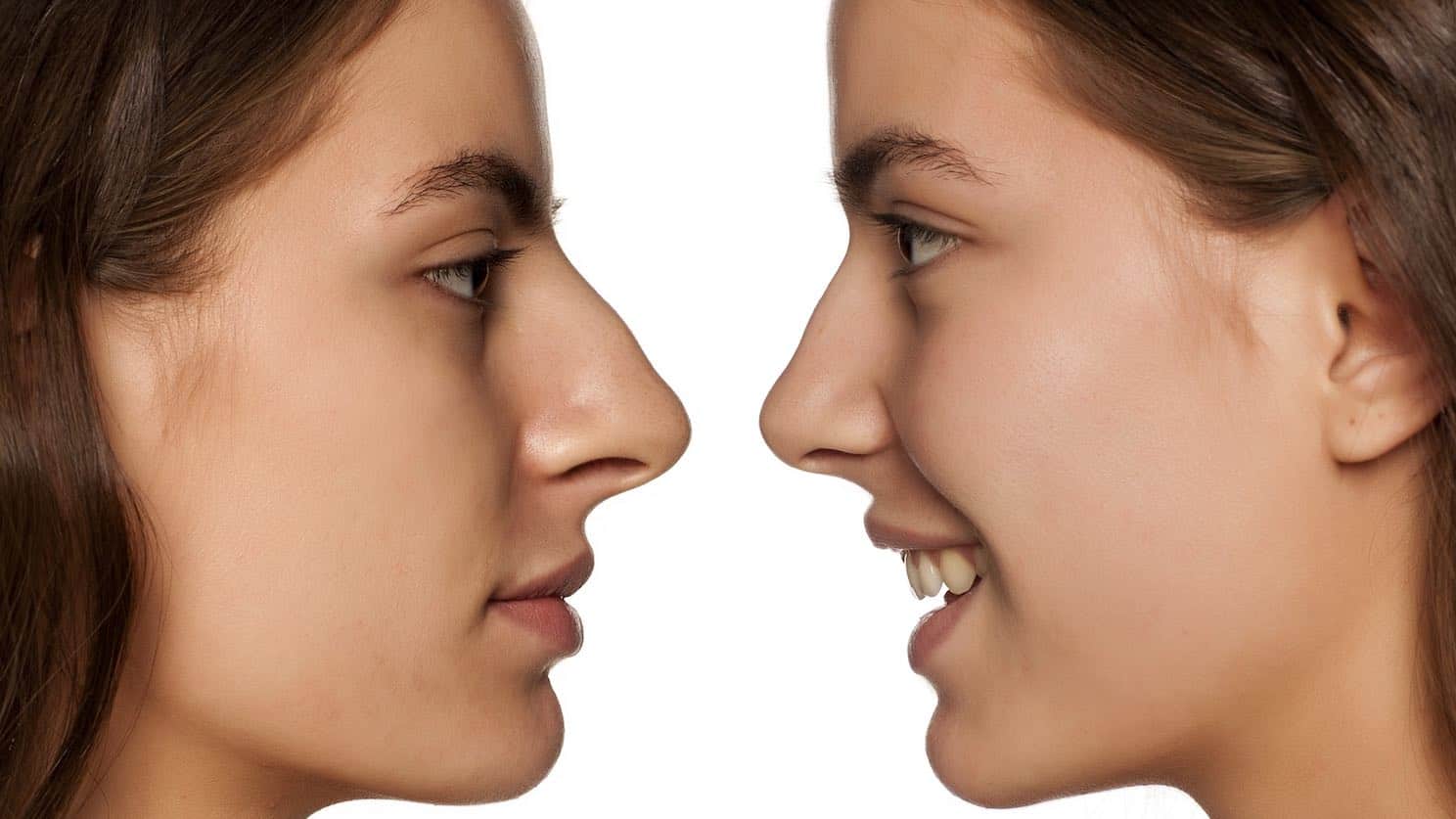 Rhinoplasty