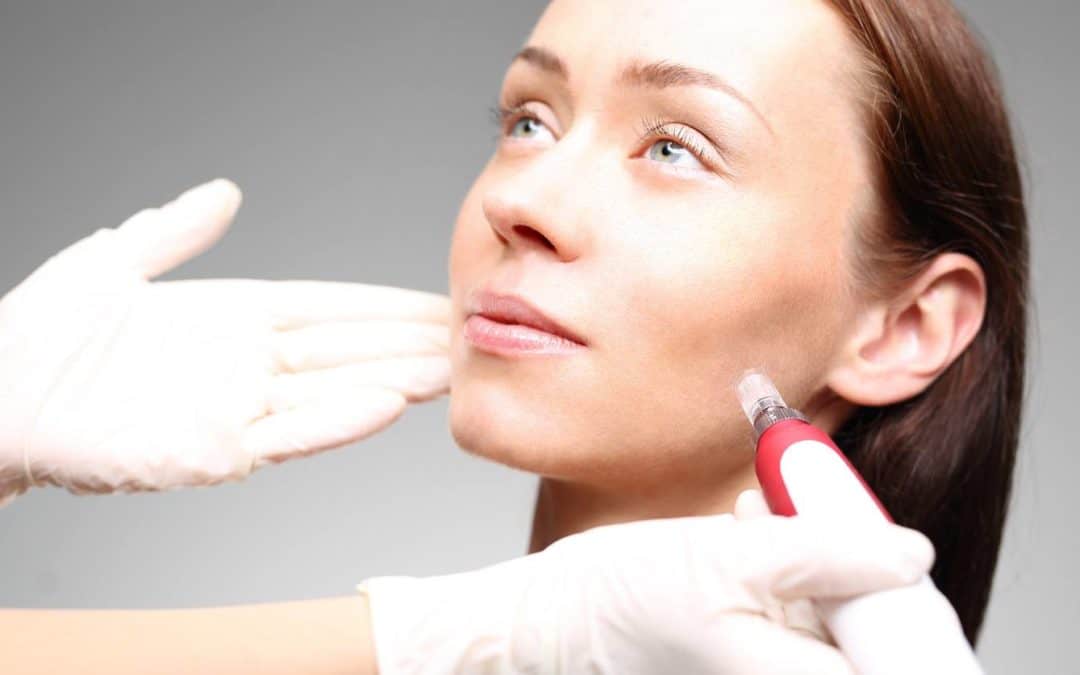 Everything You Need to Know After Microneedling
