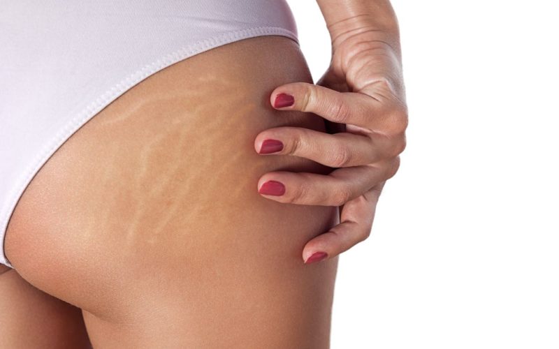 Cosmetic Surgery for Stretch Marks?