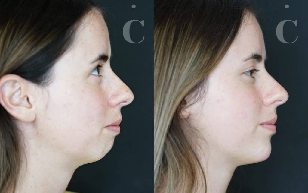 Chin filler before and after