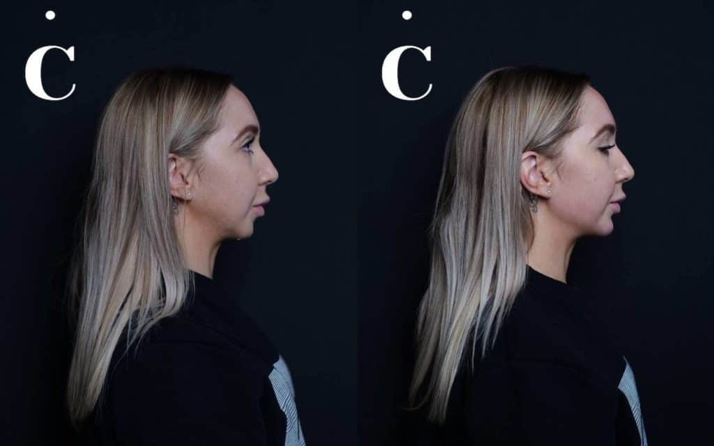 Chin & Jawline dermal fillers before and after