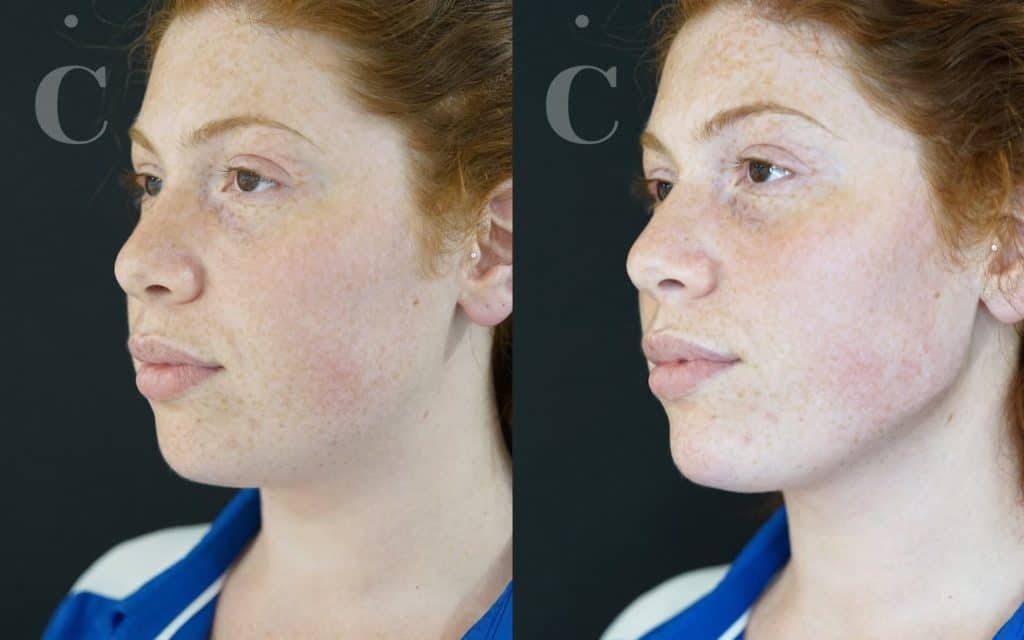 Jawline filler before and after