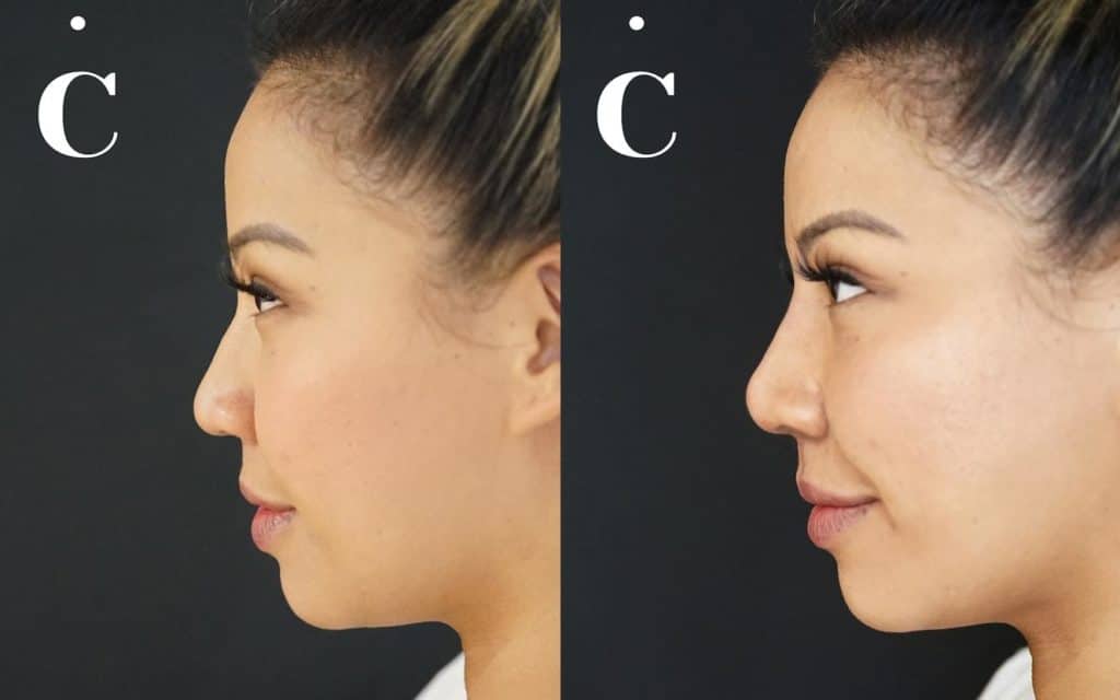 Nose filler before and after