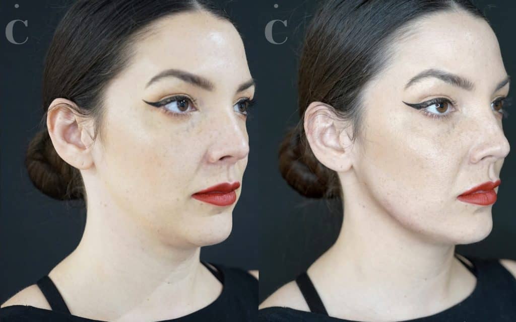 Jawline filler before and after