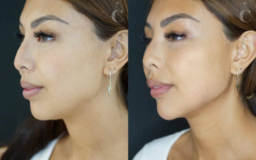 Jawline filler before and after