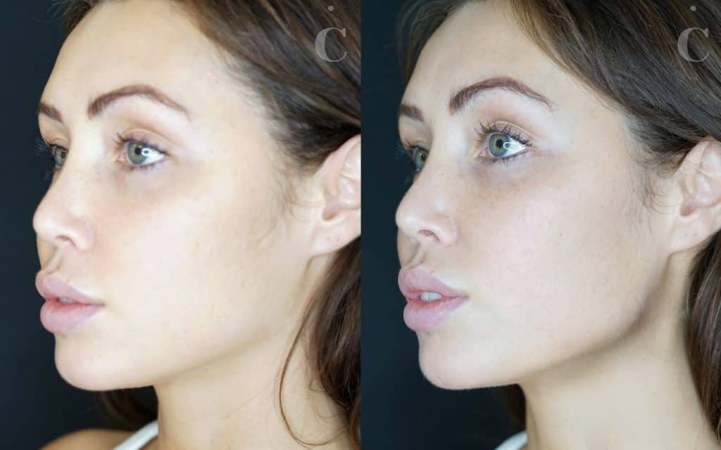 Jawline filler before and after