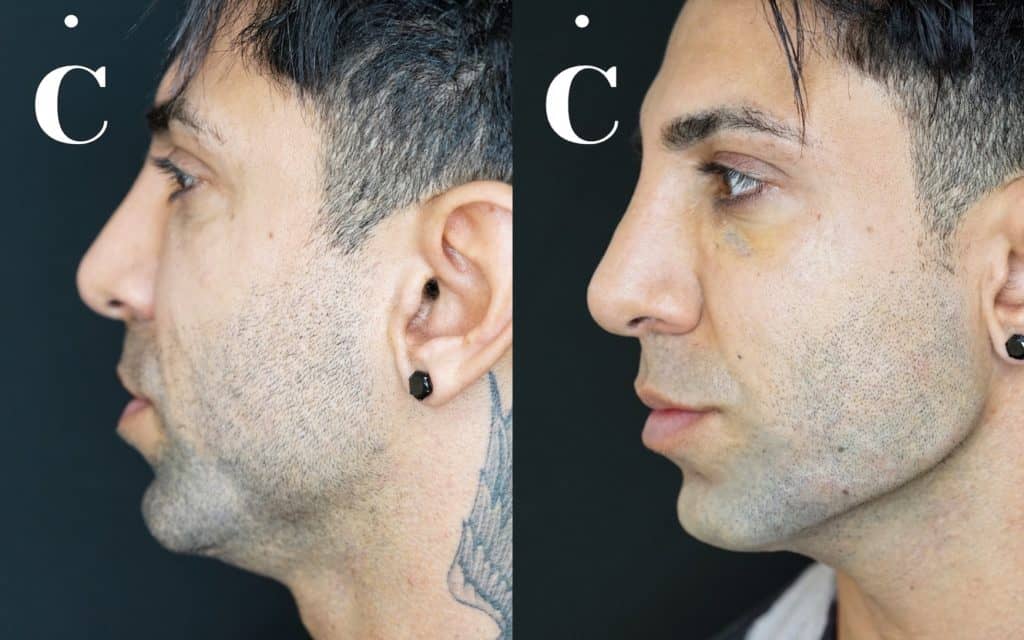Male jawline filler before and after