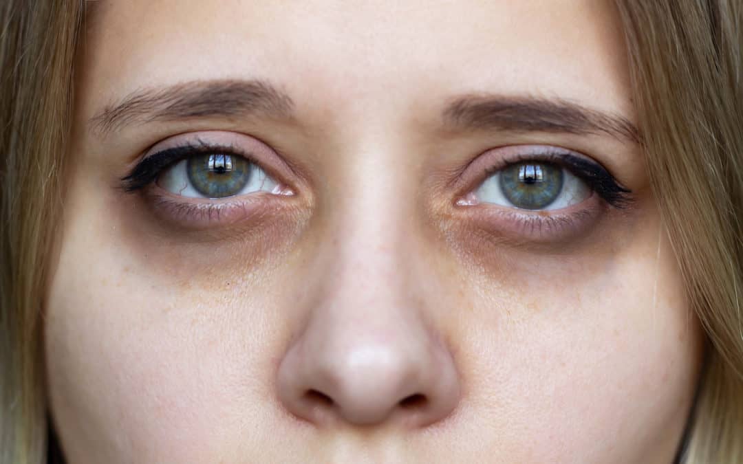 Eye Creams Don’t Fix Dark Circles