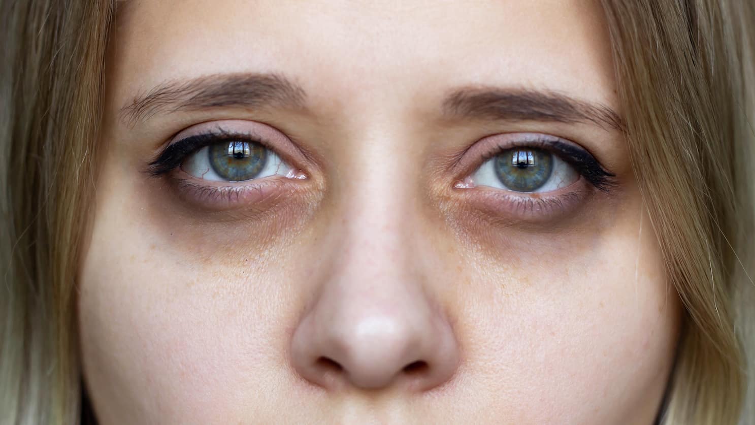 Eye Creams Don't Fix Dark Circles - Costhetics