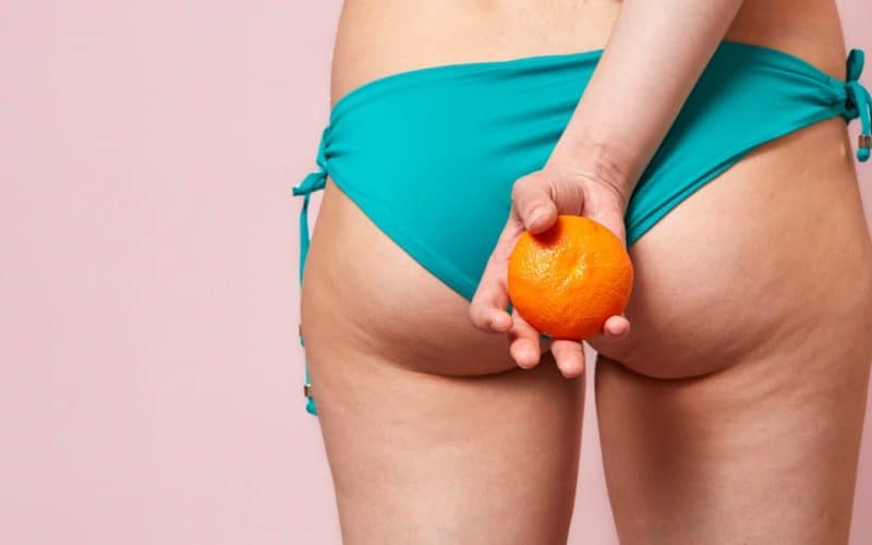 Cellulite: The Problem No-one Discusses